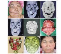 <b>3D打印技术结合虚拟复位在鼻-眶-筛粉碎性骨折整复中的应用研究</b>